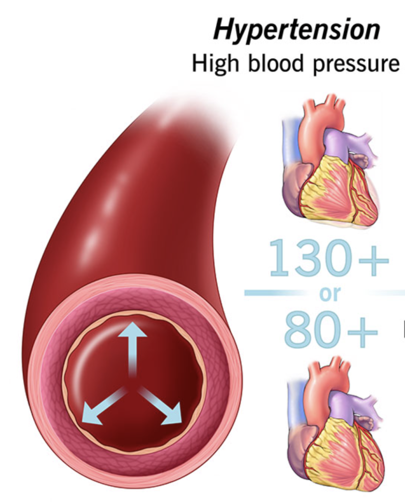 understanding-blood-pressure-hypertension Blood pressure monitor showing systolic and diastolic readings
